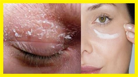 The Best Natural Treatments For Dry Skin Around Eyes Mis Remedios