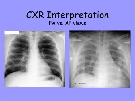 Interpretation Of Chest X Ray Ppt