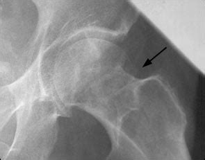 Hip Fractures in Adults - American Family Physician