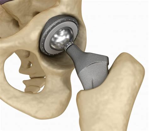 Rehabilitation After Hip Joint Replacement Surgery Lorecentral