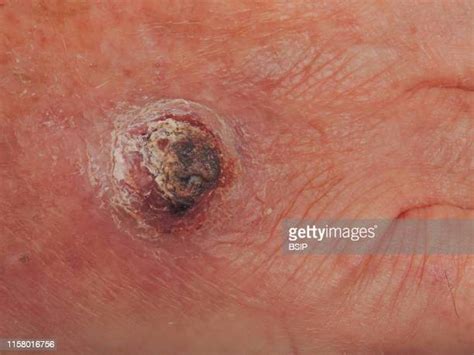 Squamous Cell Carcinoma Photos Photos And Premium High Res Pictures
