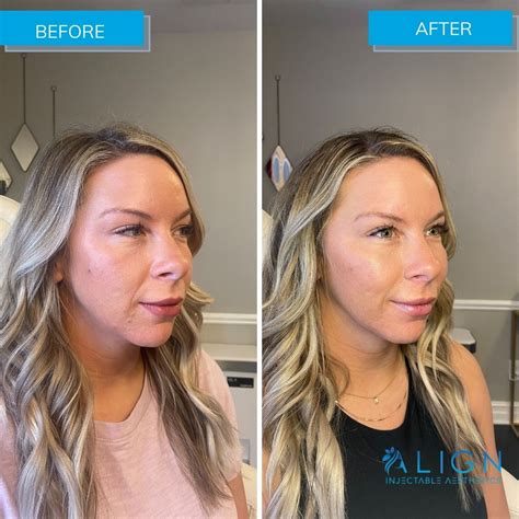 Before And After Cheek Filler Align Injectable Aesthetics