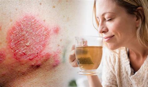 Eczema Treatment Drink Green Tea On A Daily Basis To Soothe The Rash