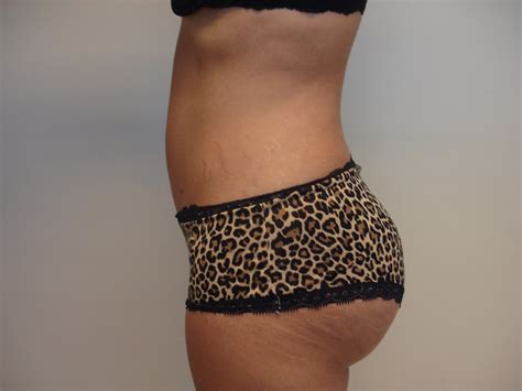Dr Bbl Specialist In Brazilian Butt Lifts And Fat Transfers