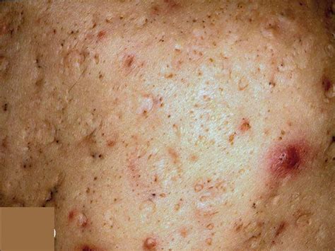 Acne Scars Causes Prevention And Treatment To Get Rid Of Acne Scars