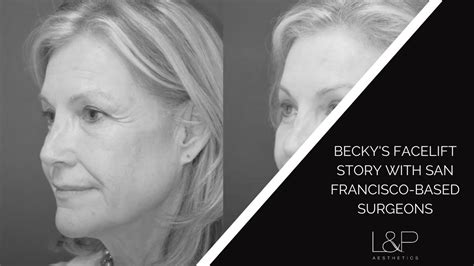 Beckys Facelift Story With San Francisco Based Surgeons Drs Lieberman And Parikh Youtube