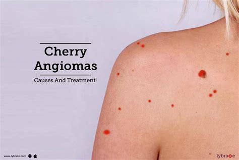 Cherry Angiomas Causes And Treatment By Sakhiya Skin Clinic