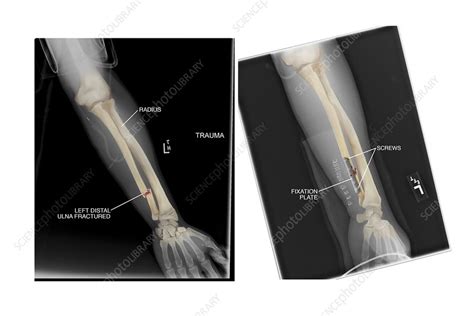 Fractured Ulna Bone And Fixation X Rays Stock Image C0210786