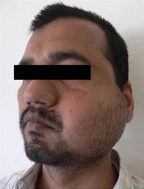 Diffuse Swelling Over The Left Side Of Face Extending From The Angle Of
