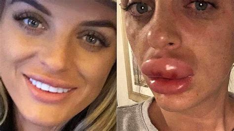 Woman Nearly Lost Top Lip After Getting Botched Fillers At Botox Party Botox Labios De