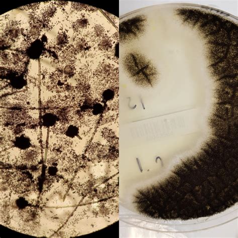 Aspergillus Niger Causing Otomycosis Fungal Ear Infection Microscopy