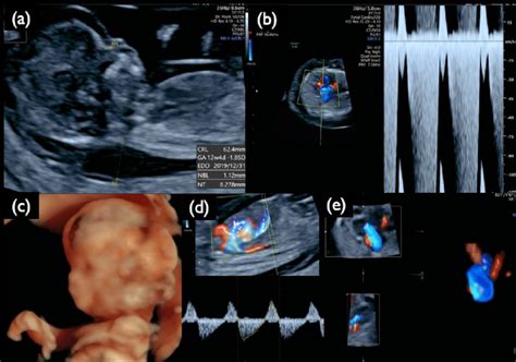 Sonographic Findings At 13 Weeks And 5 Days Of Gestation In Case Mo5
