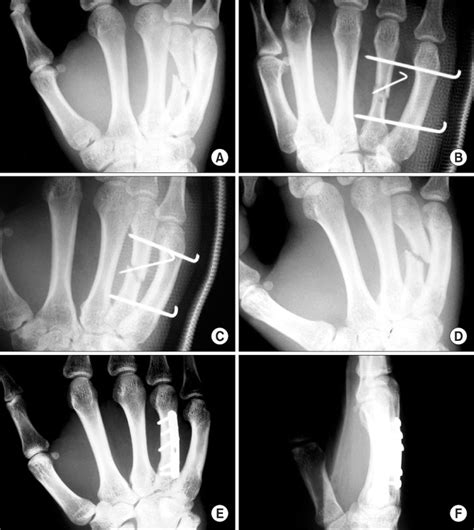 Treatment Of Metacarpal Fractures Using Transverse Kirschner Wire Fixation