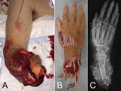 Forearm Replantation After Traumatic Complete Amputation Bmj Case Reports