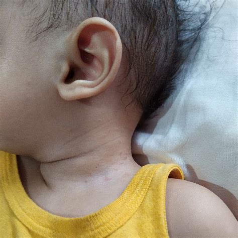 Ask The Expert My Babys Has Got Tiny Red Pimples On His Neck Back