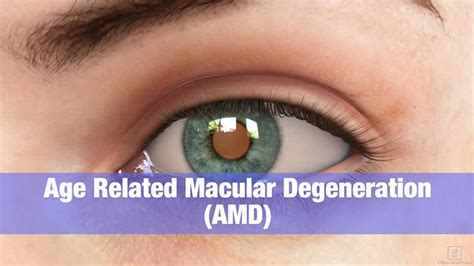 Age Related Macular Degeneration Amd Types Causes And Diagnosis