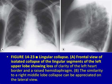 Pulmonary Lobar Collapse Essential Considerations 14 Dr Muhammad Bi