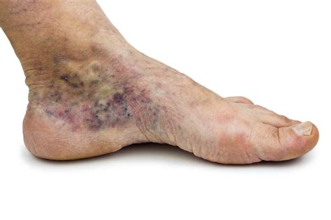 Varicose Veins Can Be Cause Of Foot Pain Dr Nicholas Campitelli