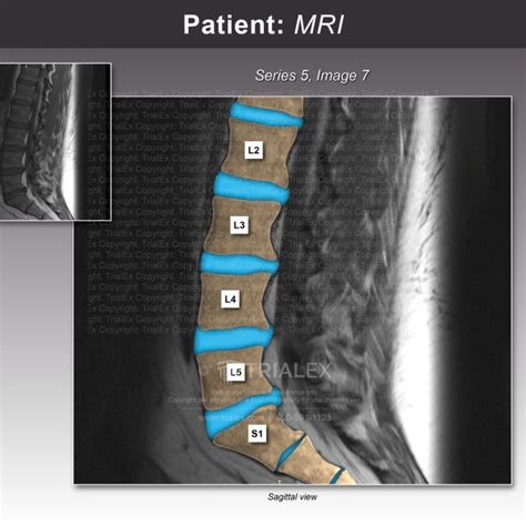 Lumbar Spine Mri Trialexhibits Inc