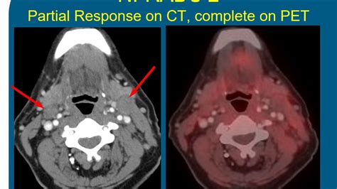 Surveillance Imaging For Head And Neck Cancer The Rise Of Nirads Youtube