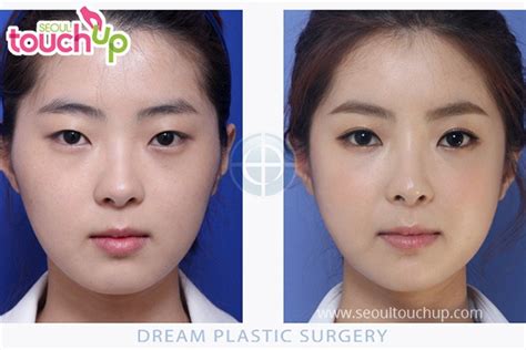 Eyelid Surgery In Korea Seoul Touchup