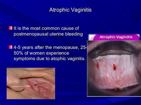 atrophic vaginitis as related to bleeding pictures