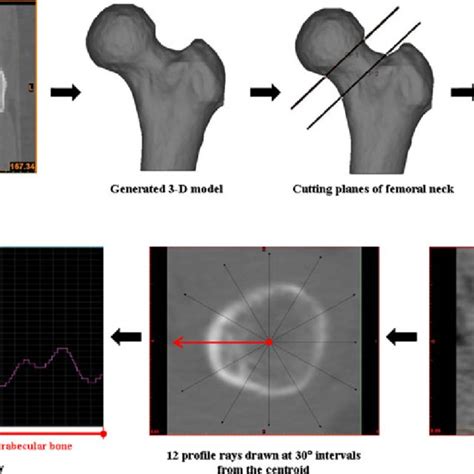 A Typical Fe Model Of The Proximal Femur With Boundary Conditions With