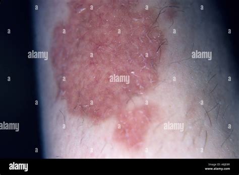 Diabeticorum Ndl Is A Rash Which Usually Occurs On The Legs Stock