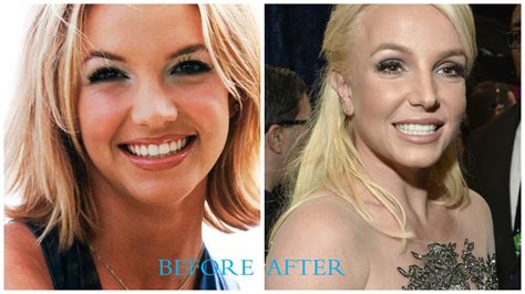 Britney Spears Plastic Surgery Before And After Pictures Famousfaceshub