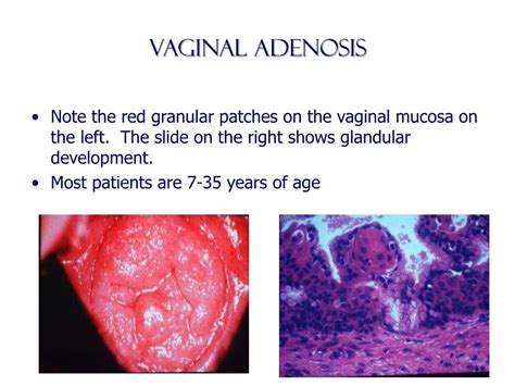Ppt Benign Diseases Of The Vulva Vagina And Cervix Powerpoint Presentation Id6890859