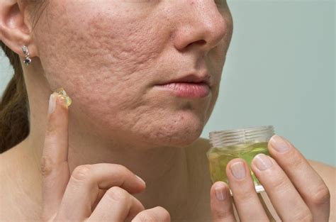 How To Get Rid Of Acne Scars Quickly And Naturally Livestrongcom