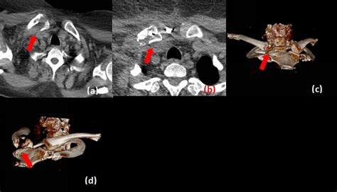 A Morphology Of The Plate B Anterior Dislocation Of The Right