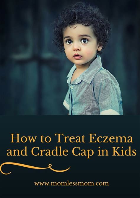 How To Treat Eczema And Cradle Cap In Kids How To Treat Eczema