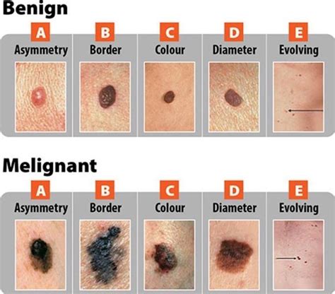 Pin By Dana On Skin Care Skin Moles Cancerous Moles Skin Spots