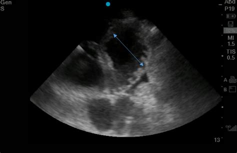 Ultrasound Case Of The Month — Brown Emergency Medicine