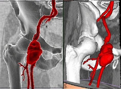 Right Femoral Infectious Aneurysm Ct Scan Stock Image C