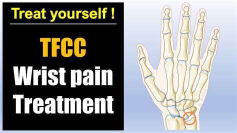 Wrist Pain Pinky Side Treatment Tfcc Injury Pain Relief Massage And
