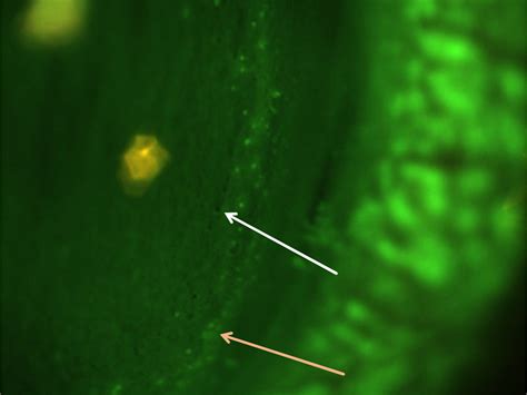 Corneal Epithelial Bullae After Short Term Wear Of Small Diameter