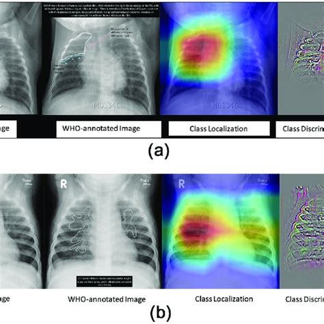 A Activation Map Of Pep Frontal Radiographs Of The Chest In A Child