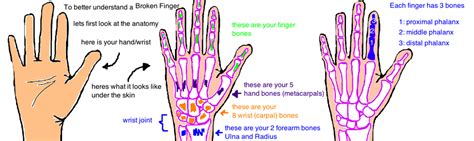 Broken Finger (phalanx fracture) — Bone Talks