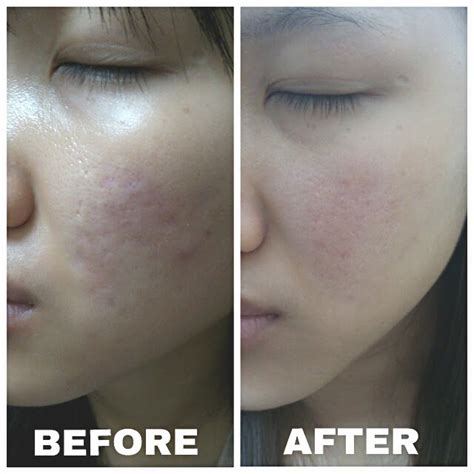 Quinnipiac University Transfer Laser Pore Treatment Before And After