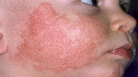 Common Childhood Skin Problems Health Digest