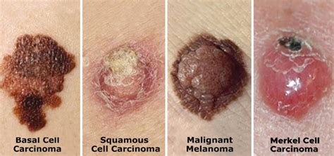 4 Types Of Skin Cancer