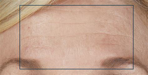 How To Get Rid Of Forehead Lines