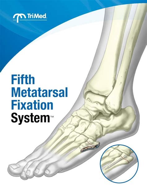 Pdf Fifth Metatarsal Fixation Lmt Surgical · Screws Indications Screw Plate Zone I Zone Ii
