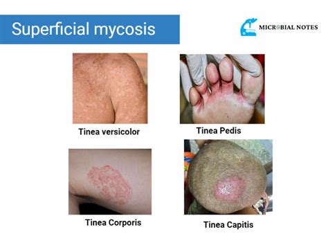Superficial Mycosis Overview Types Diagnosis And Treatment Microbial Notes