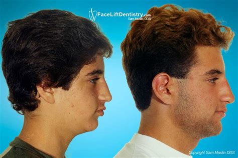 If the feature that concerns you most is a small chin, the solution is straightforward: Before and After Photos