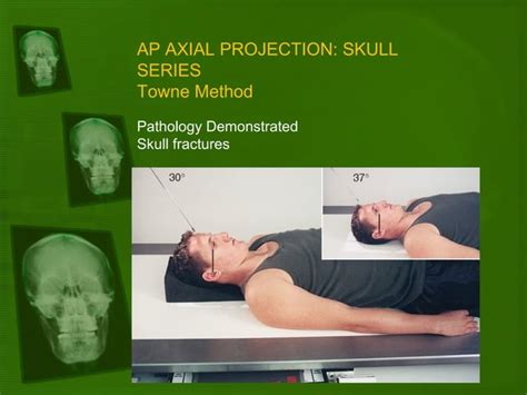 Positioning And Radiographic Anatomy Of The Skull