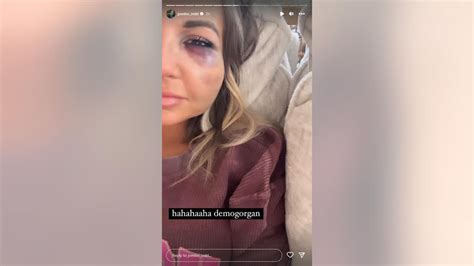 Morgan Wallens Ex Kt Smith Shares Facial Injuries After Shes Involved
