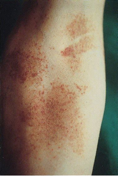 Pigmented Purpura Like Eruption As Cutaneous Sign Of Mycosis Fungoides